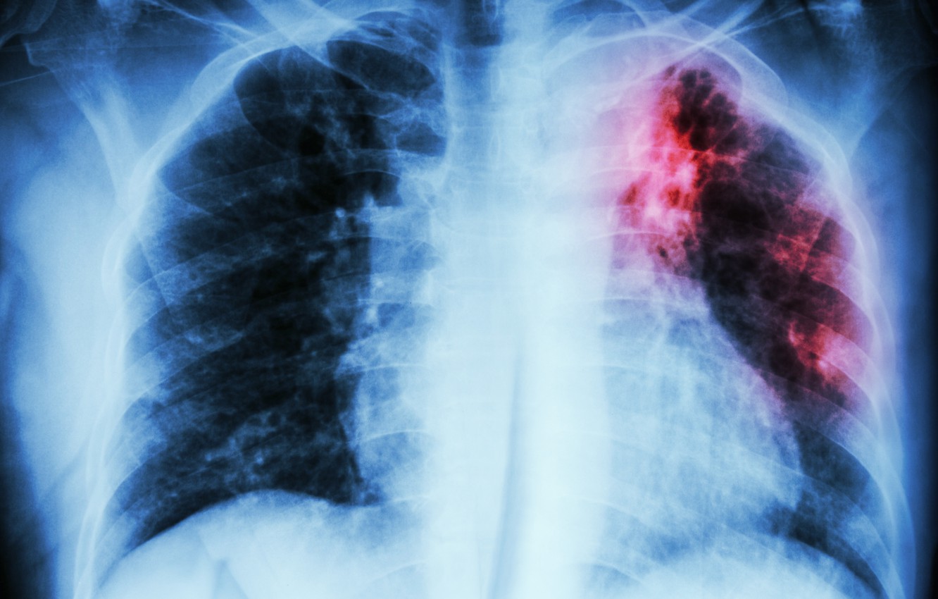 Photo Wallpaper Stain, Disease, Lungs, Radiography, - Lungs Infected With Tuberculosis , HD Wallpaper & Backgrounds