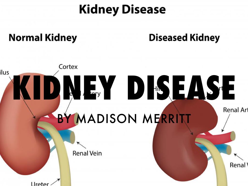Refer To Outline - Presentation Of Kidney Disease , HD Wallpaper & Backgrounds