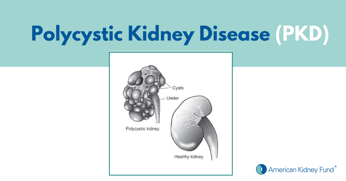 Polycystic Kidney Disease Symptoms, Treatments, & Causes - Adpkd Treatment , HD Wallpaper & Backgrounds