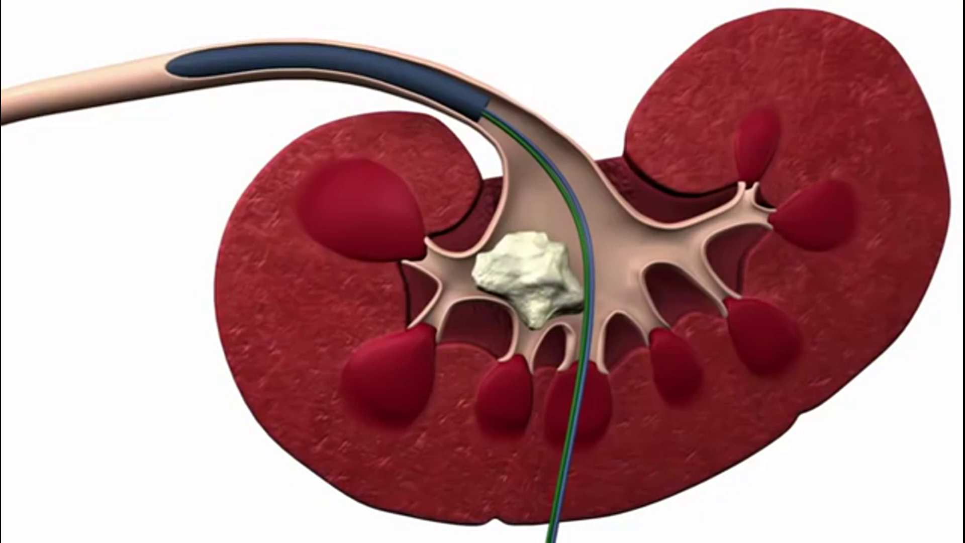 Kidney Stone 3d Medikal Animation Stock Video Footage - Kidney Stone , HD Wallpaper & Backgrounds