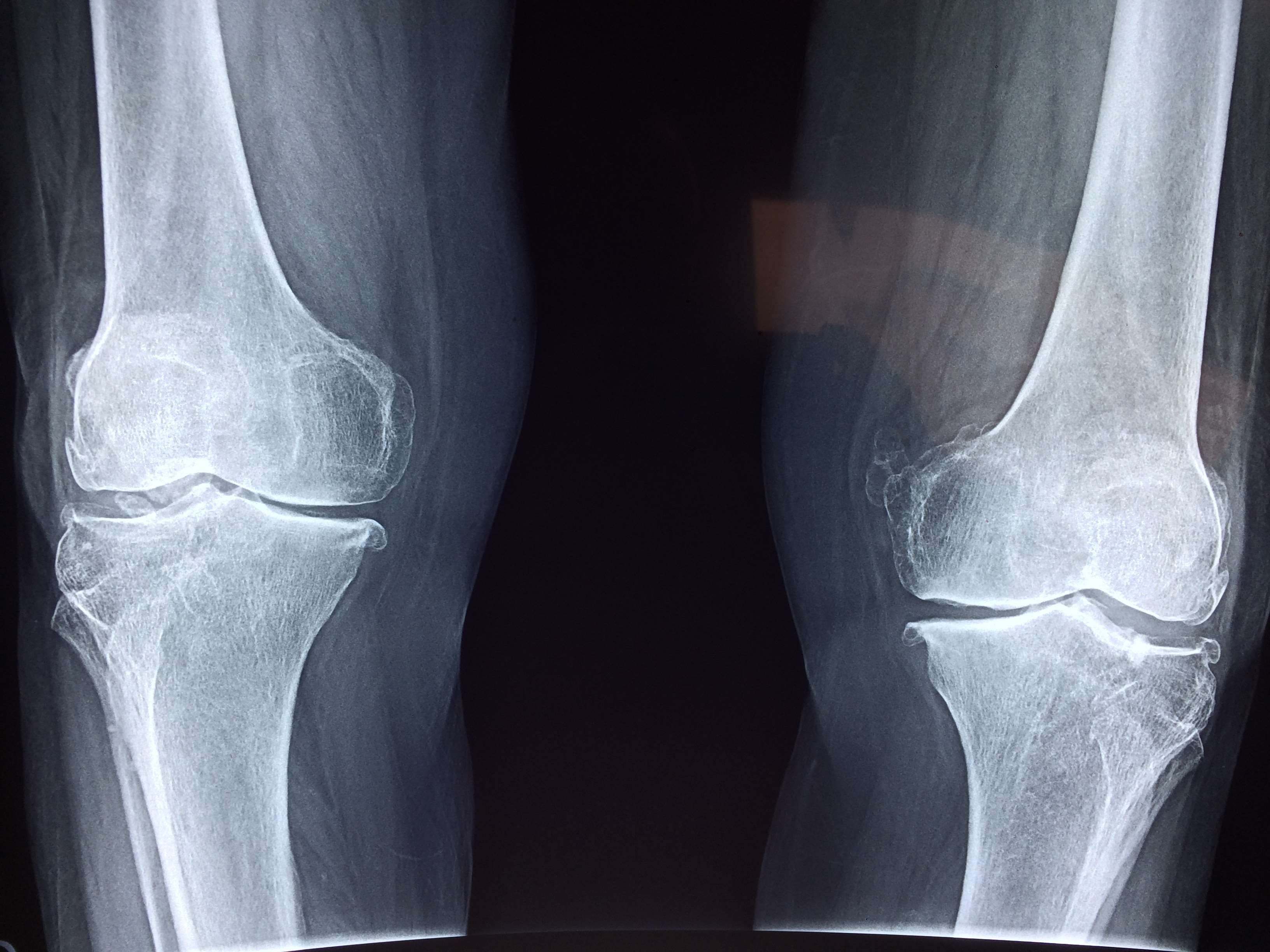 Anatomy, Bone, Cartilage, Disease, Health, Hospital, - Osteoarthritis Knee , HD Wallpaper & Backgrounds