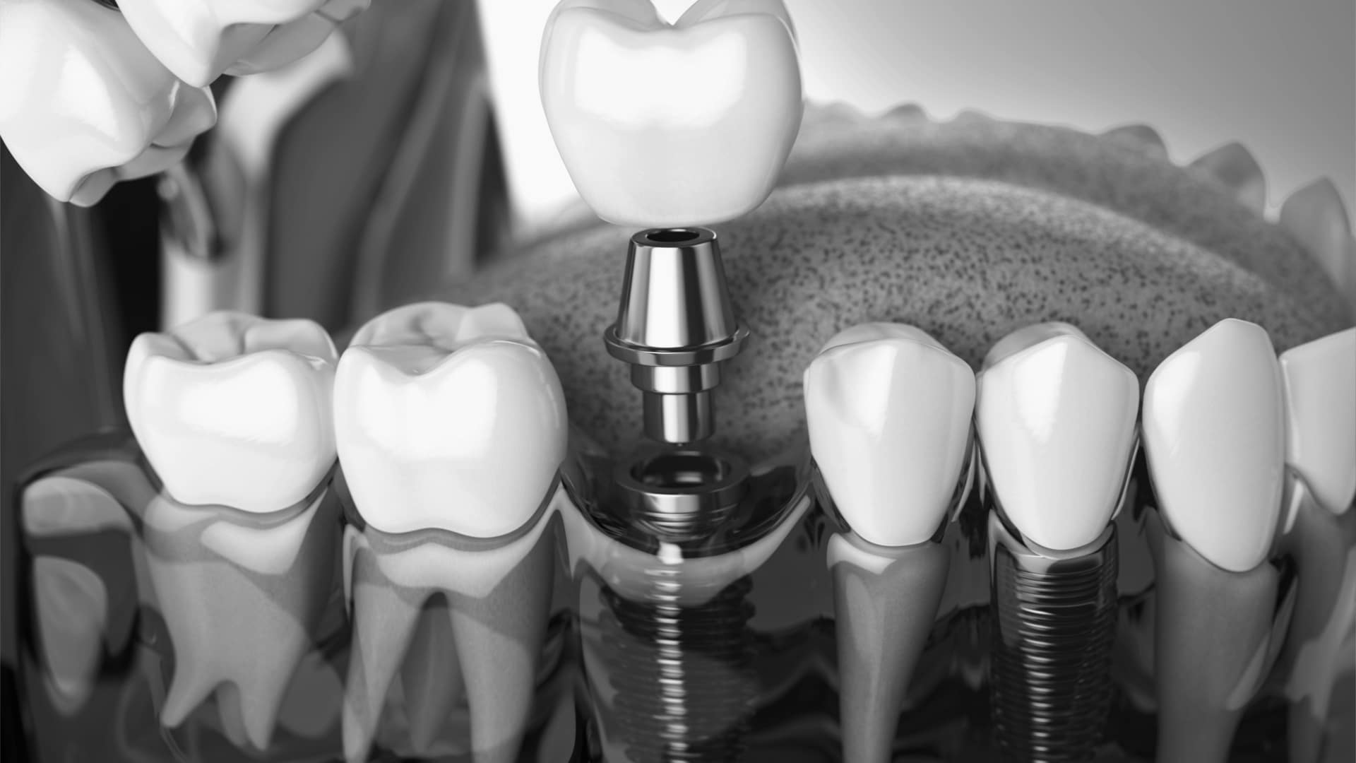 Dental Implant , HD Wallpaper & Backgrounds