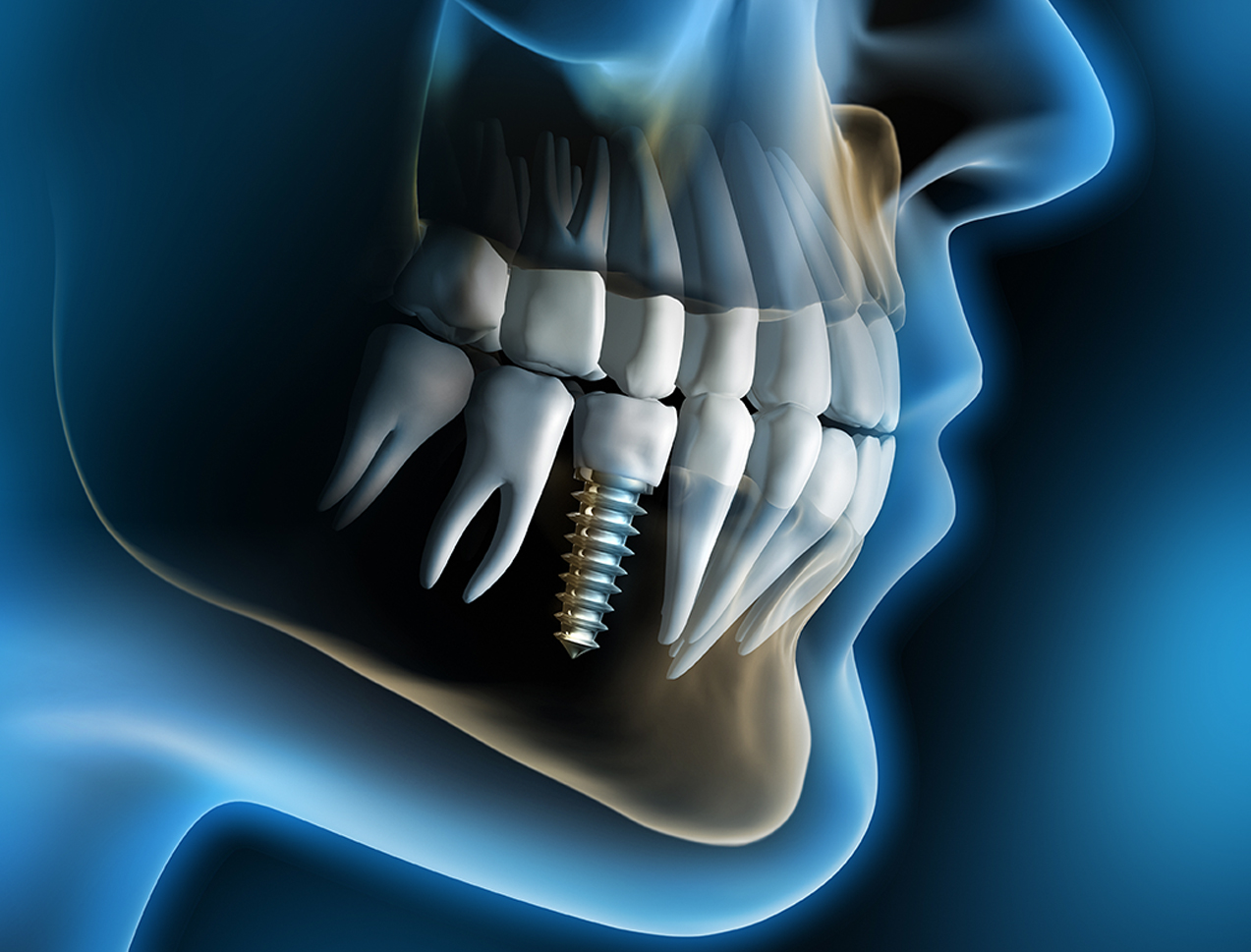 Dental Implants And Prosthetics - Dental Implant And Prosthetic , HD Wallpaper & Backgrounds