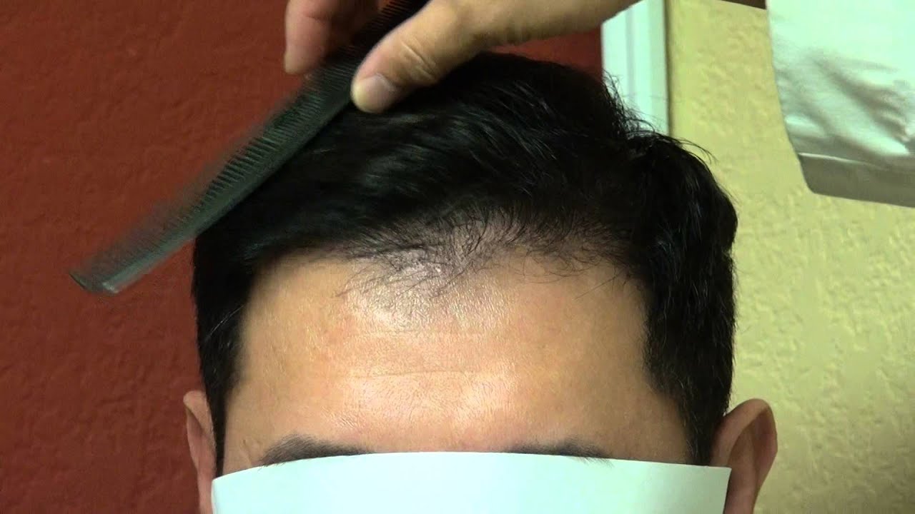 Get Free High Quality Hd Wallpapers Korean Hair Transplant - Hair Transplant Before And After Korean , HD Wallpaper & Backgrounds