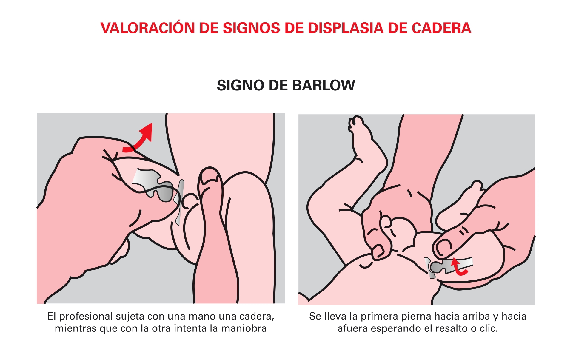 Signo De Displasia De Cadera - Signos De Displasia De Cadera , HD Wallpaper & Backgrounds
